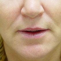 Hyaluronic Acid Before